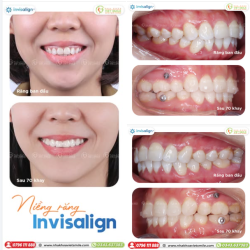 NIỀNG INVISALIGN RĂNG HẾT HÔ - "HELLO" NỤ CƯỜI ĐẸP