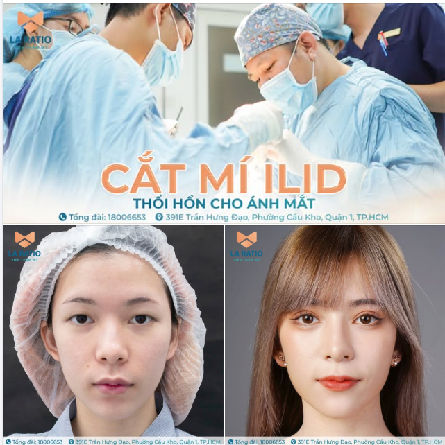 Cắt mí iLid - Không chỉ là kỹ thuật, mà là giá trị thẩm mỹ trong từng đường nét!