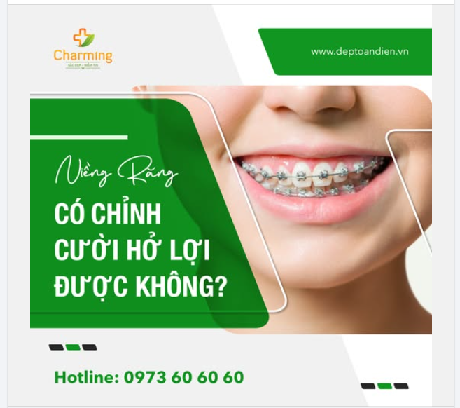 ĐANG NIỀNG RĂNG CÓ THỂ CHỈNH CƯỜI HỞ LỢI KHÔNG?