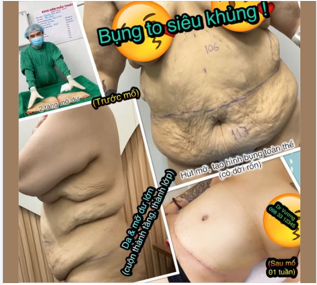 Xử trí ca bụng siêu khủng, bụng 117cm trước phẫu thuật cho bạn gái đến từ Philippines kết quả đầu tiên sau 7 ngày !