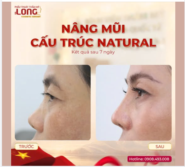 TỐN BAO NHIÊU ĐỂ CÓ CHIẾC MŨI NHƯ THẾ NÀY?
