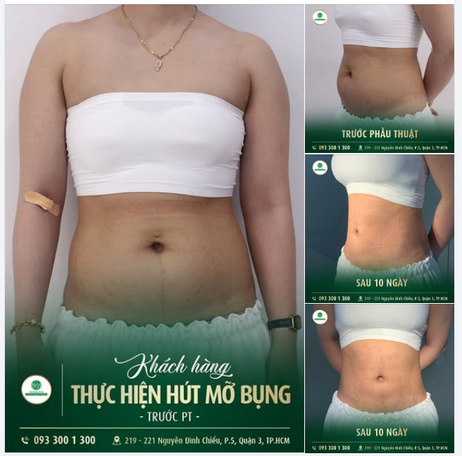 TRẢ LẠI BODY QUYẾN RŨ VẠN NGƯỜI MÊ SAU 10 NGÀY HÚT MỠ!