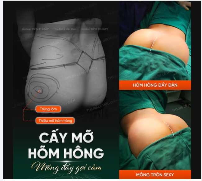 CẤY MỠ HÕM HÔNG - MÔNG ĐẦY GỢI CẢM