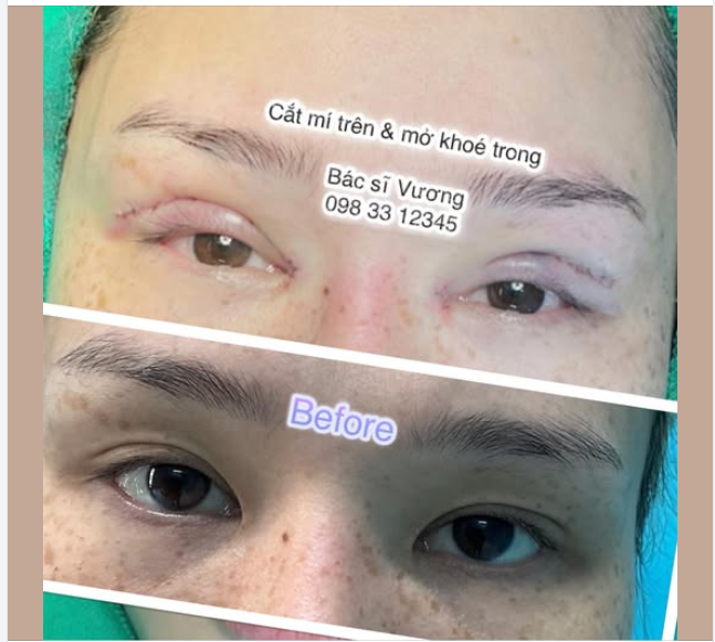 Cắt mí giờ giá đắt thật í các bạn nhỉ, toàn mấy chục trịu …