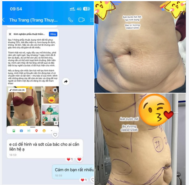 Hậu phẫu sau hút mỡ, tạo hình bụng bao lâu thì đẹp ?