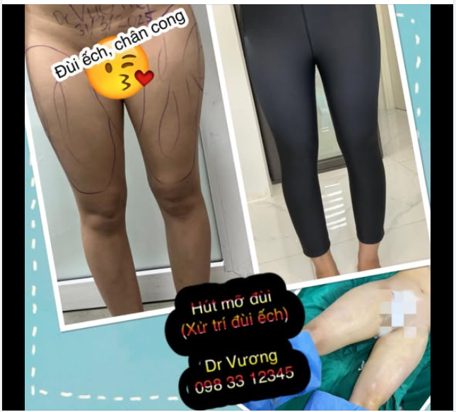 Hậu phẫu sau chục ngày mà chân đã thon-thẳng-dài nhìu rồi nhé, đùi ếch - chân cong đã được xử trí triệt để