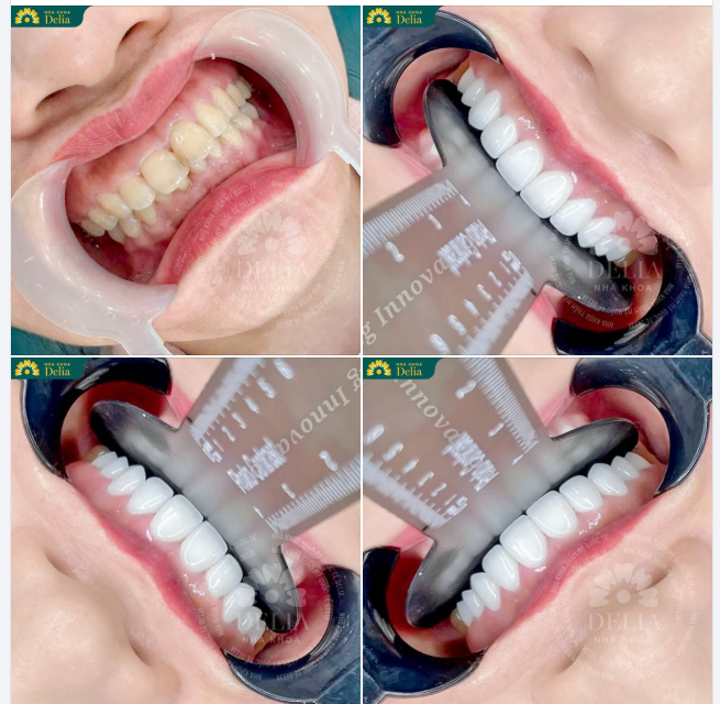 Răng sứ đẹp nhất…khi nó phù hợp!!!