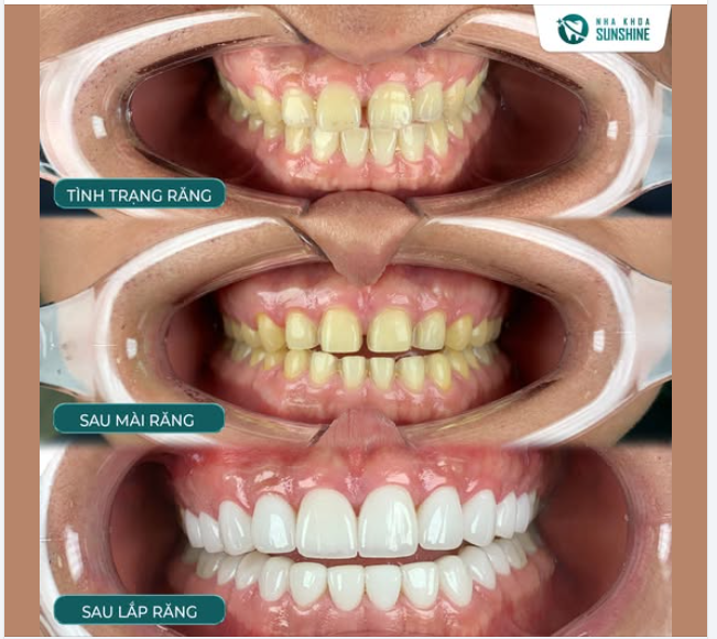 DÁN SỨ VENEER – PHƯƠNG PHÁP HIỆN ĐẠI NHẤT GIÚP BẢO TỒN TỐI ĐA RĂNG THẬT