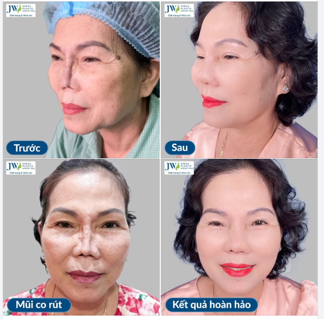 BÁC SĨ TÚ DUNG GIẢI CỨU THÀNH CÔNG CHIẾC MŨI CO RÚT, ĐỨT TRỤ CỦA NGƯỜI PHỤ NỮ U60 SAU 7 SỐNG TRONG MẶC CẢM