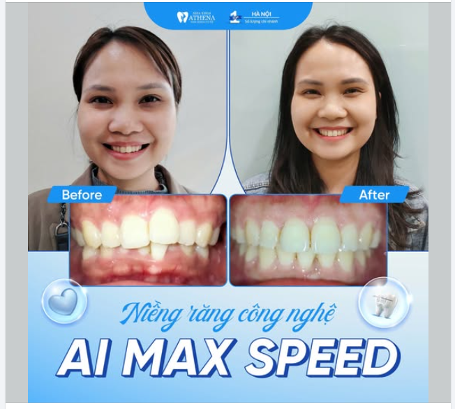 TỪ RĂNG KHẤP KHỂNH, CẮN SÂU ​​​​​​​ ĐẾN NỤ CƯỜI TỰ TIN VÀ HÀI HOÀ