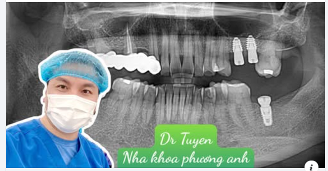 Sau khi cấy ghép implant cần kiêng gì?