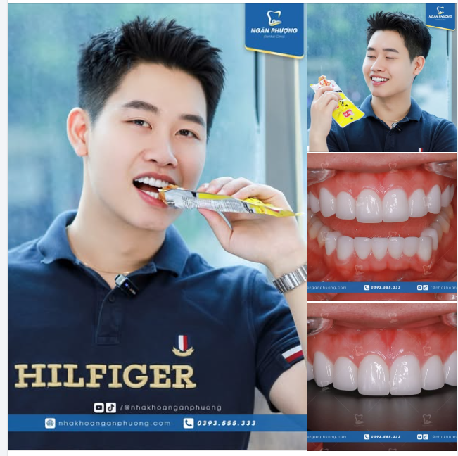 Tự tin ăn cả thế giới với Tuấn Anh sau 6 tháng bọc sứ
