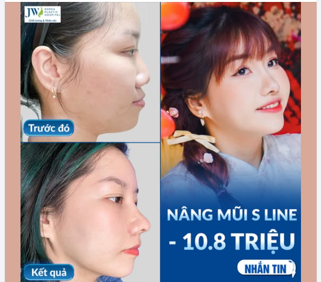 CHỊ GÁI 9X THĂNG HẠNG NHAN SẮC, MŨI ĐẸP TỰ NHIÊN SAU NÂNG MŨI S LINE TẠI JW