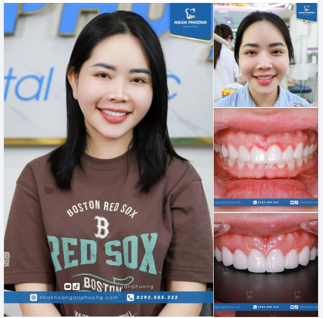 Làm lại răng sứ sung sướng đến thế nào?