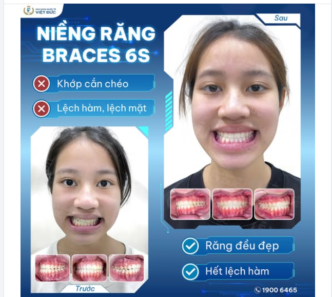 TỪ GƯƠNG MẶT LỆCH ĐẾN NỤ CƯỜI CHUẨN TỈ LỆ VÀNG