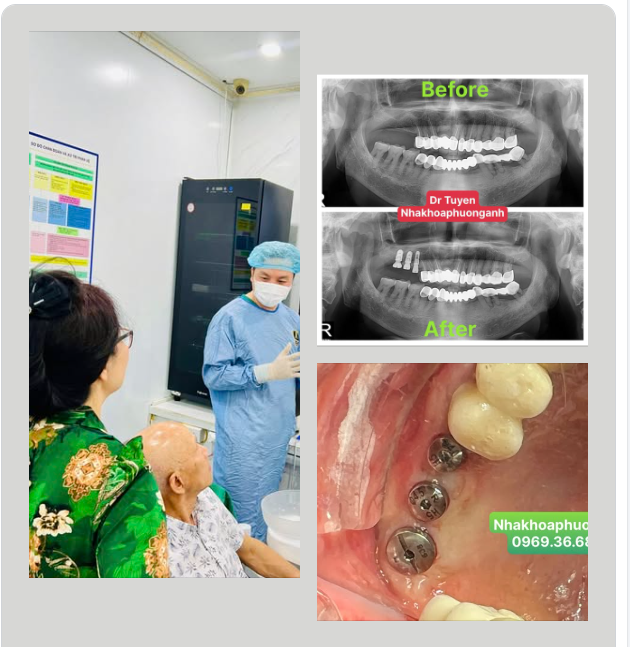 Case IMPLANT nâng xoang kín phẫu thuật Không lật vạt free hand đẹp như Robot phẫu thuật