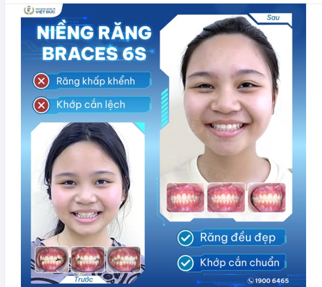 TỪ NỤ CƯỜI NGẠI NGÙNG ĐẾN TỰ TIN RẠNG RỠ – CHUYỆN NIỀNG RĂNG CỦA TƯỜNG VY