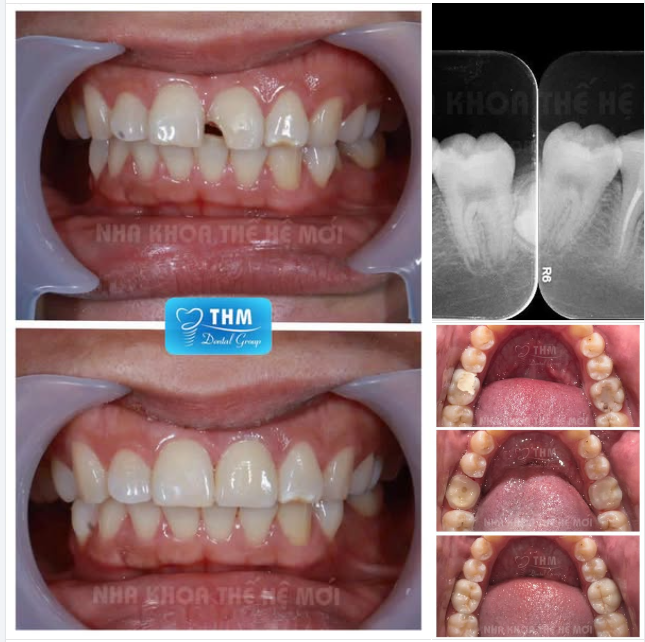 Một ca trám răng kết hợp dán sứ được thực hiện tại Nha khoa Thế Hệ Mới – kết quả khiến khách hàng vô cùng hài lòng. Chi tiết trong hình ảnh đính kèm.