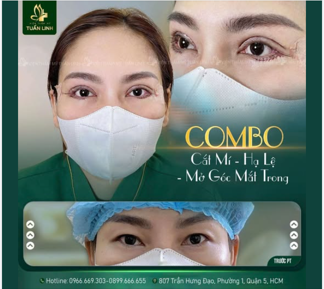 Combo Cắt mí + Hạ lệ + Mở góc mắt trong Tinh chỉnh đôi mắt đẹp hoàn hảo!!