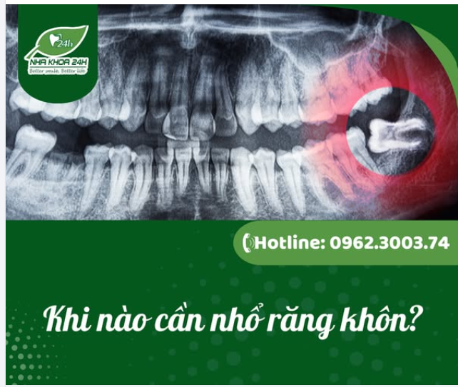 KHI NÀO CẦN NHỔ RĂNG KHÔN?