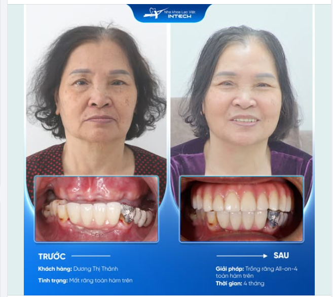 U80 ĂN NGON SỐNG KHỎE NHỜ TRỒNG RĂNG IMPLANT TẠI NHA KHOA LẠC VIỆT INTECH