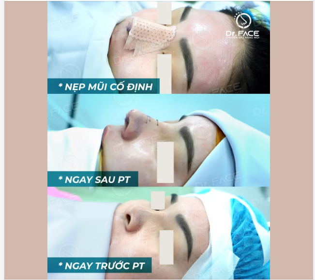 NẸP MŨI SAU PHẪU THUẬT – NHỎ NHƯNG “CÓ VÕ”