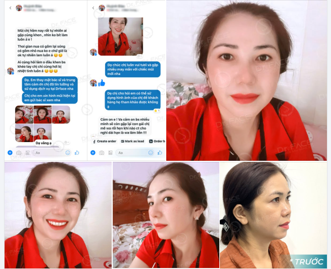 “MŨI ĐẸP MÀ AI CŨNG TƯỞNG MŨI THẬT…”