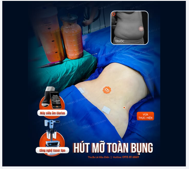 “Mình là nạn nhân của làm bụng tại Dr Điền  Vì hút mỡ xong đẹp quá giờ chỉ thích diện bikini khoe body suốt thôi…”