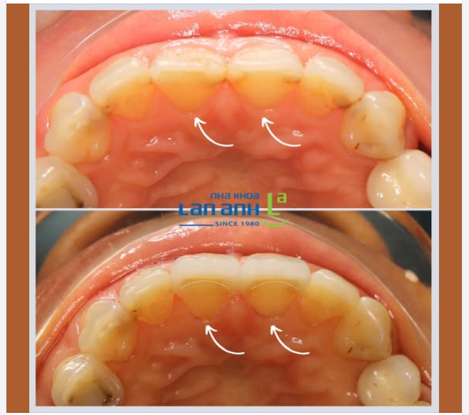 Veneer sứ làm tại nha khoa Lan Anh: mỏng, nhẹ và có màu đẹp tự nhiên lắm ạ