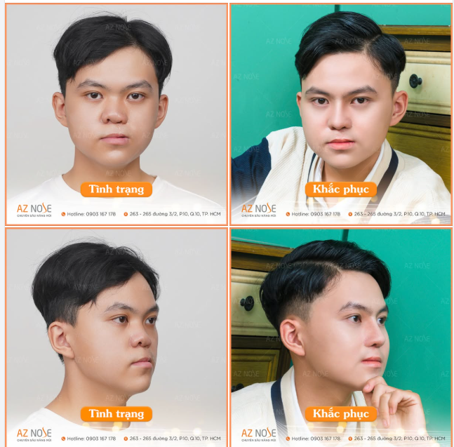 Nam sinh "dị tật mũi môi" đến từ Tây Ninh thay đổi ngoạn mục sau 2 năm tái tạo mũi