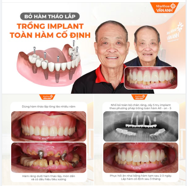 HÀM THÁO LẮP RƠ LỎNG – CHỊU ĐỰNG ĐẾN BAO GIỜ?
