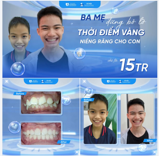 BA MẸ ƠI! ĐỪNG BỎ LỠ THỜI ĐIỂM VÀNG NIỀNG RĂNG CHO CON