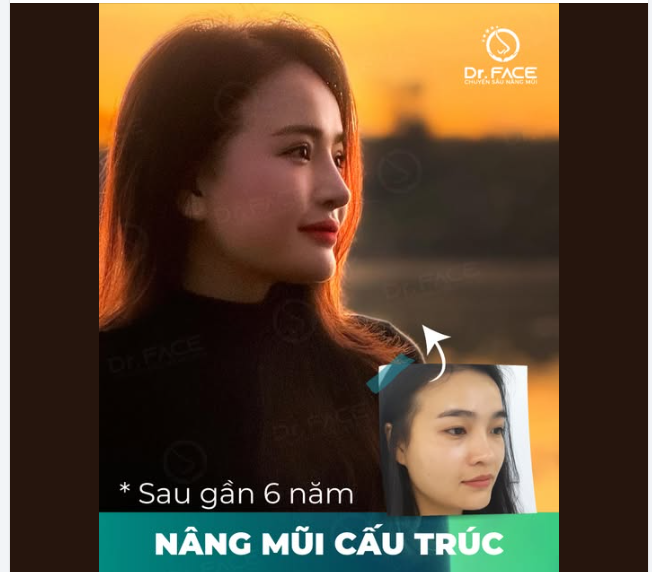 FEEDBACK 6 NĂM NÂNG MŨI – CHƯA TỪNG HỐI HẬN, CHỈ THẤY BIẾT ƠN