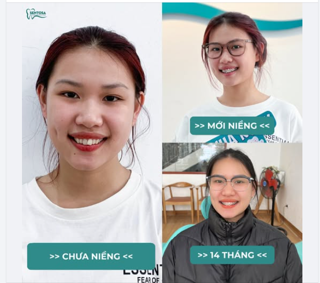HỌC SINH - SINH VIÊN CÓ NÊN ĐI NIỀNG RĂNG MẮC CÀI KHÔNG?
