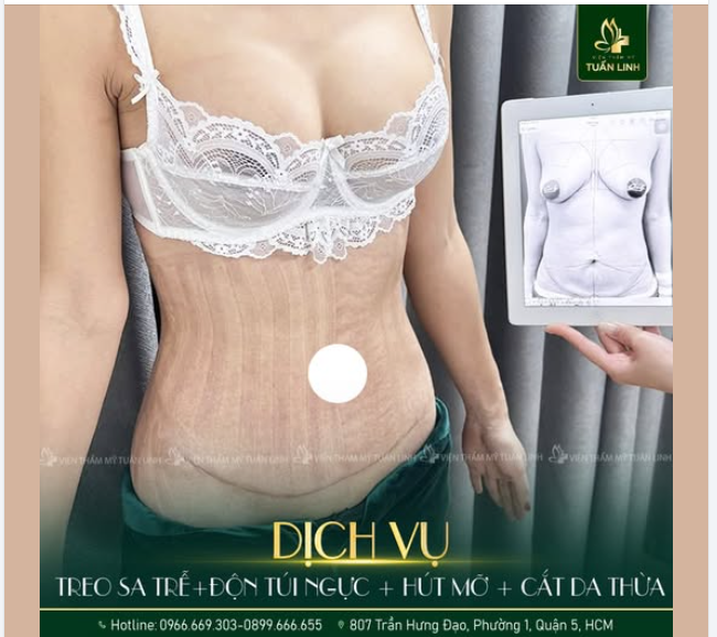 Treo sa trễ + đặt túi + hút mỡ + tạo hình thành bụng  Combo đẹp gợi cảm, lấy lại sự tự tin cho phái nữ.