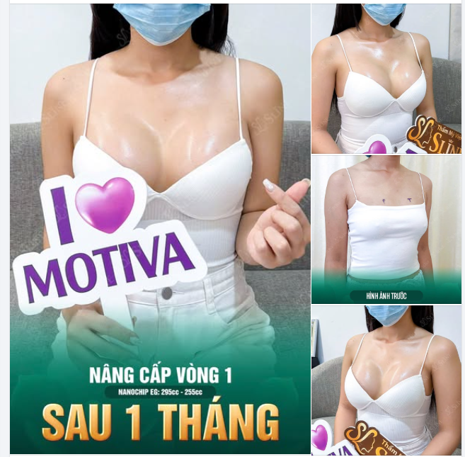 Cô ấy không chọn sống mãi với V1 "xẹp lép"  Cô ấy chọn nâng cấp V1 với Sline!