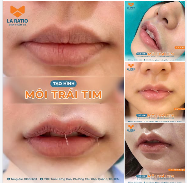 TẠO HÌNH MÔI TRÁI TIM - CHÚM CHÍM XIÊU LÒNG CHÀNG