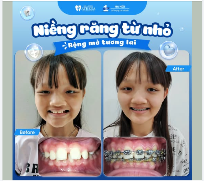 NIỀNG RĂNG - MÓN QUÀ Ý NGHĨA NHẤT CHO CON NHÂN DỊP QUỐC TẾ THIẾU NHI