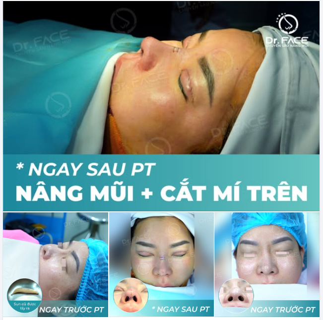 NGAY SAU COMBO PT: Nâng mũi sụn sườn + Cắt mí trên + Độn silicone thái dương