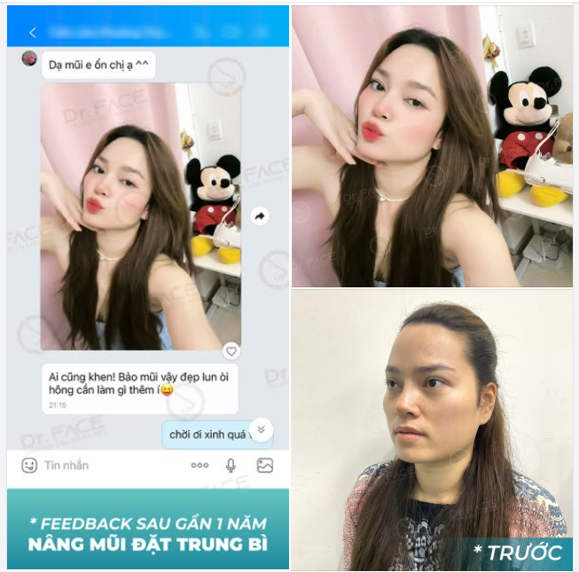 FEEDBACK sau 1 năm THÁO SỤN ĐẶT TRUNG BÌ MỠ: KHÔNG CẦN NÂNG LẠI