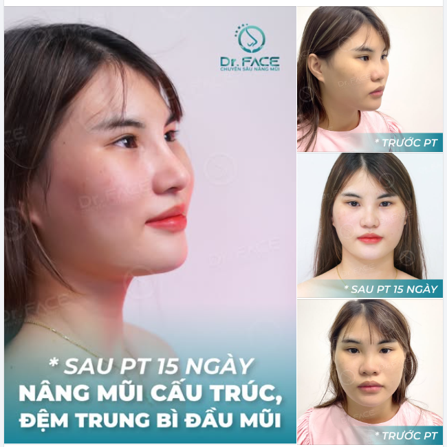 2 VẤN ĐỀ LỚN CỦA CHIẾC MŨI NÀY LÀ GÌ?