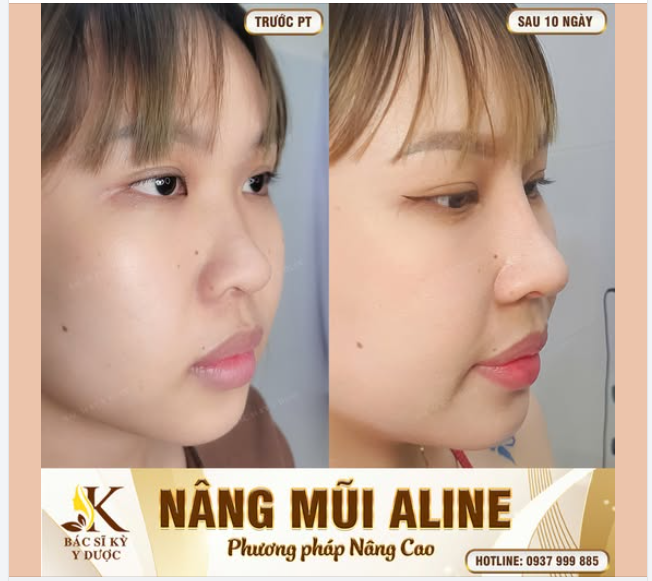 10 ngày sau Nâng Mũi ALINE – nhẹ nhàng mà khác biệt rõ nét!