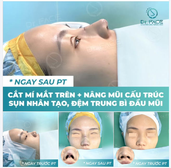 MŨI THẤP, ĐẦU MŨI TO, MẮT MỘT MÍ – LÀM 1 LẦN, ĐẸP TOÀN DIỆN