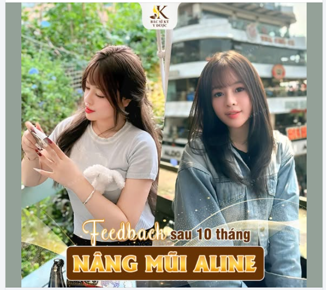 10 tháng sau Nâng Mũi ALINE – Vẫn đẹp như ngày đầu