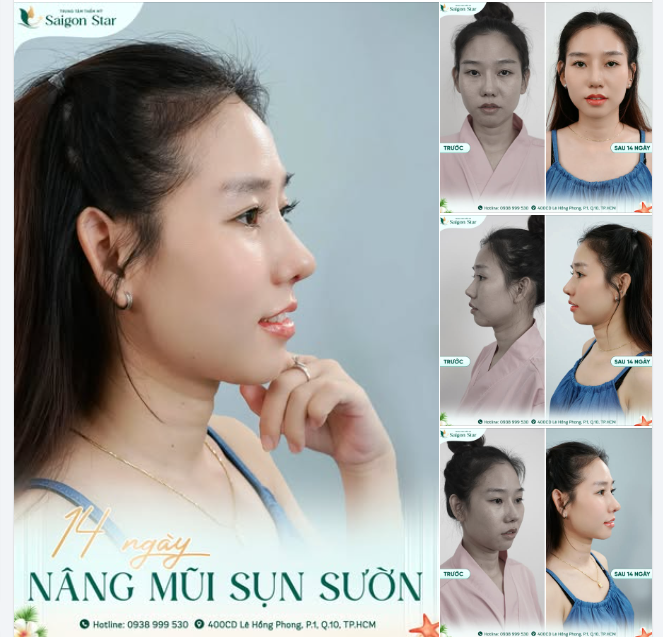 NÂNG MŨI SỤN SƯỜN MŨI ĐẸP KHÔNG TÌ VẾT SAU 14 NGÀY