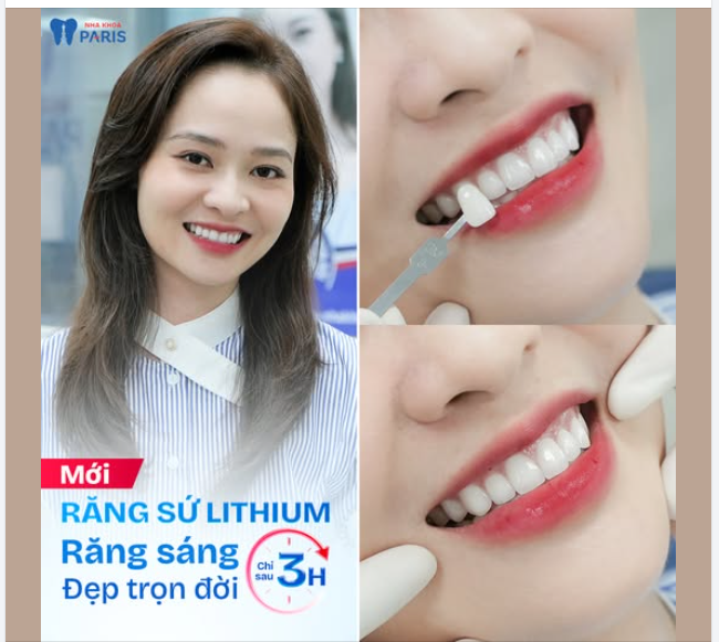 Tin vui cho người bận rộn! Sở hữu răng sáng khỏe chỉ sau 3 giờ với răng sứ Lithium.