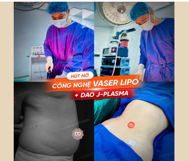 HÚT MỠ CÔNG NGHỆ VASER LIPO + DAO J-PLASMA - HIỆU QUẢ "TUYỆT VỜI"