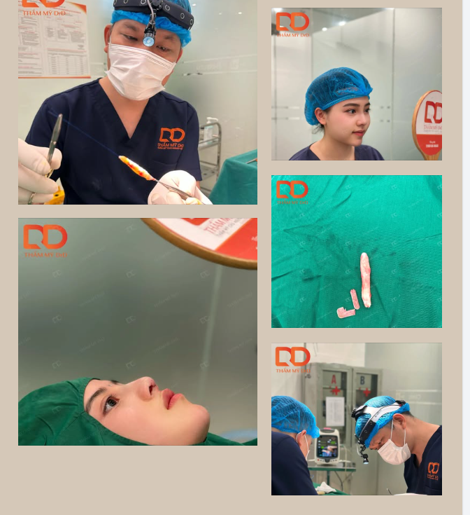 Sử dụng trung bì mỡ tự thân thay thế sụn nhân tạo khắc phục tình trạng mũi viêm, co rút lộ chất liệu.