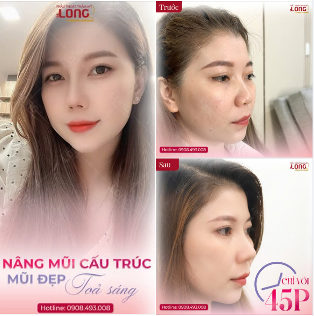 NẾU BẠN CHƯA ĐỦ TỰ TIN VỀ NHAN SẮC CỦA MÌNH HÃY THỬ 1 LẦN…NÂNG MŨI