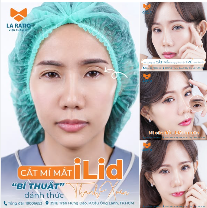 Đây là phương pháp tạo hình mắt hai mí hiện đại được nghiên cứu và phát triển bởi Bác sĩ Võ Thành Trung từ năm 2019.